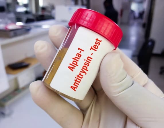 Alpha-1 Antitrypsin Deficiency and Lung Disease: What You Need to Know Image